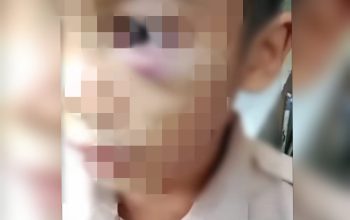 Viral di Medsos, Bocah SD di Toboali Diduga Jadi Korban Kekerasan Ayah Kandung